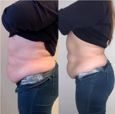 Before and after 12 sessions: visibly slimmer waist