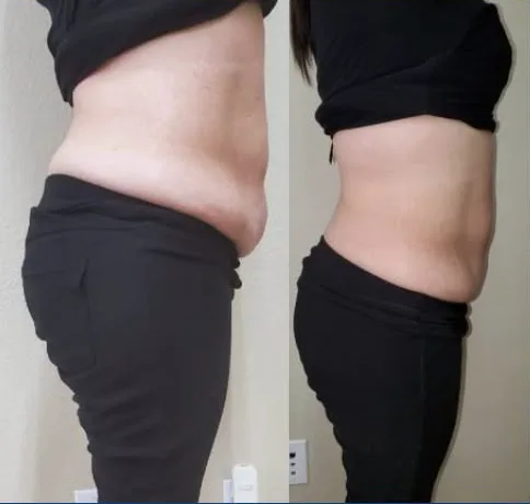 Before and after 6 sessions: visibly flatter stomach